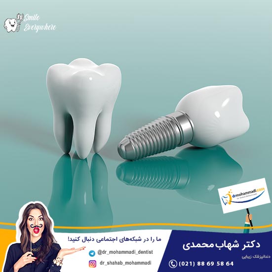 ایمپلنت های دندانی در مقایسه با دندان طبیعی: تفاوت ها و شباهت ها - کلینیک دندانپزشکی دکتر شهاب محمدی